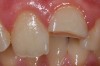 Intrebari frecvente despre fracturile dentare