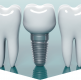 Implanturile dentare din zirconiu sau din titan?