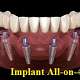 Implant all on 4
