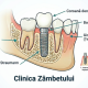 Cum decurge ședința de inserare a implantului la Clinica Zâmbetului?