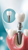 Implant dentar – De ce nu este recomandat să amâni înlocuirea unui dinte lipsă?