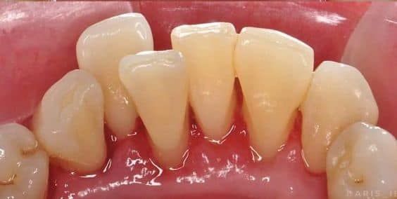 Dr. Alecsandrescu Stomatologie Pitesti Implanturi dentare Pitesti poza 12