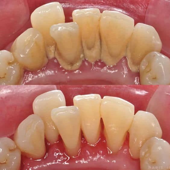 Dr. Alecsandrescu Stomatologie Pitesti Implanturi dentare Pitesti poza 11