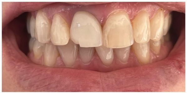 Dr. Alecsandrescu Stomatologie Pitesti Implanturi dentare Pitesti poza 13