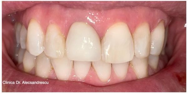 Dr. Alecsandrescu Stomatologie Pitesti Implanturi dentare Pitesti poza 14