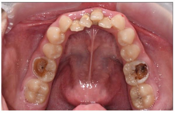 DentArbre poza 13