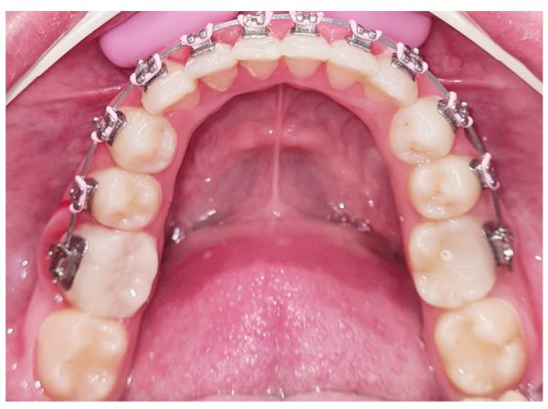 DentArbre poza 14