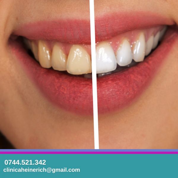 Heinerich - Clinica Stomatologica Sector 6 - Implant Dentar Drumul Taberei poza 3