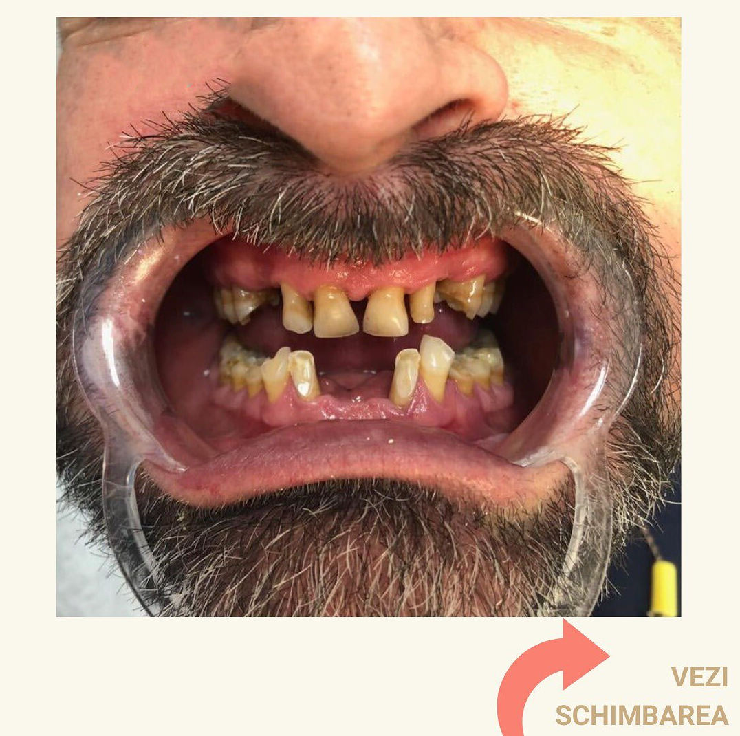 Dental Chic - Clinică Stomatologică Cluj - Implant Dentar Cluj - Dinti Ficsi Cluj poza 13