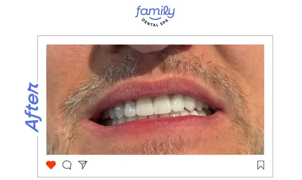 Family Dental Spa Otopeni - Implant Dentar si Dinti Ficsi poza 12