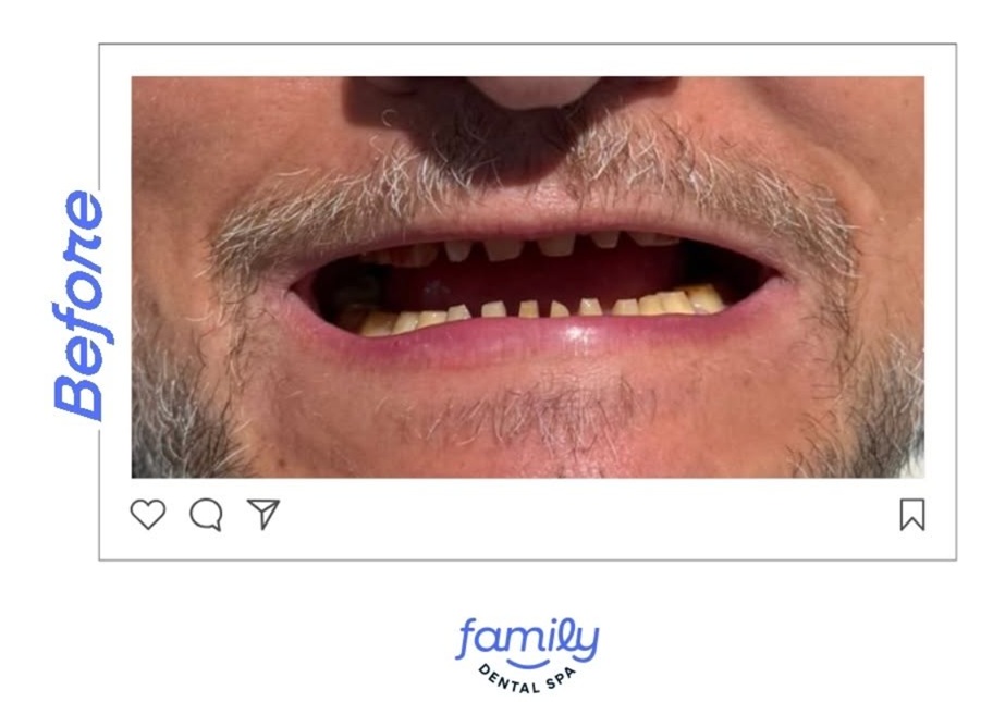 Family Dental Spa Otopeni - Implant Dentar si Dinti Ficsi poza 11