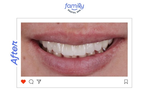 Family Dental Spa Otopeni - Implant Dentar si Dinti Ficsi poza 14
