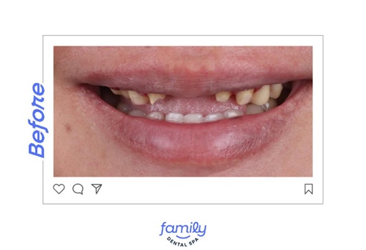 Family Dental Spa Otopeni - Implant Dentar si Dinti Ficsi poza 13