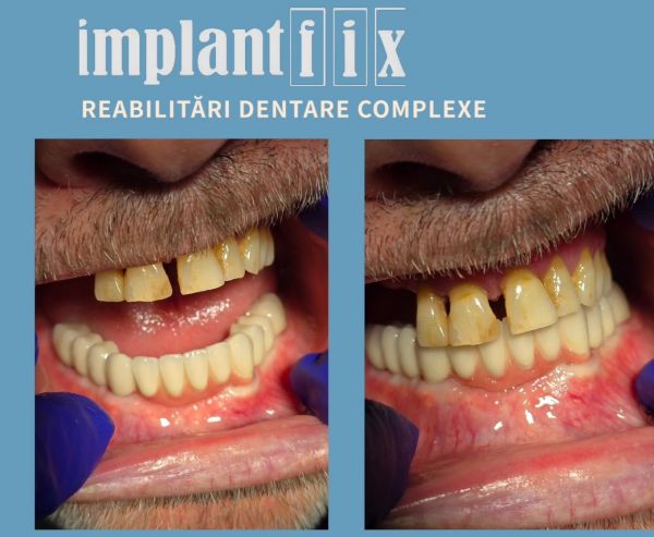 ImplantFix - Clinica de Implanturi dentare poza 13