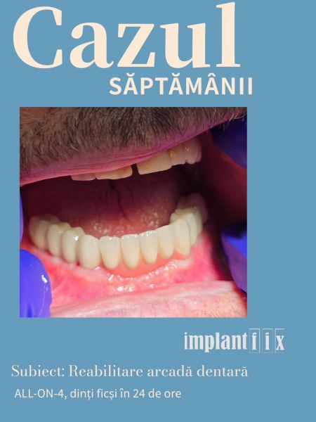 ImplantFix - Clinica de Implanturi dentare poza 16