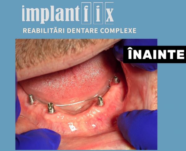 ImplantFix - Clinica de Implanturi dentare poza 11
