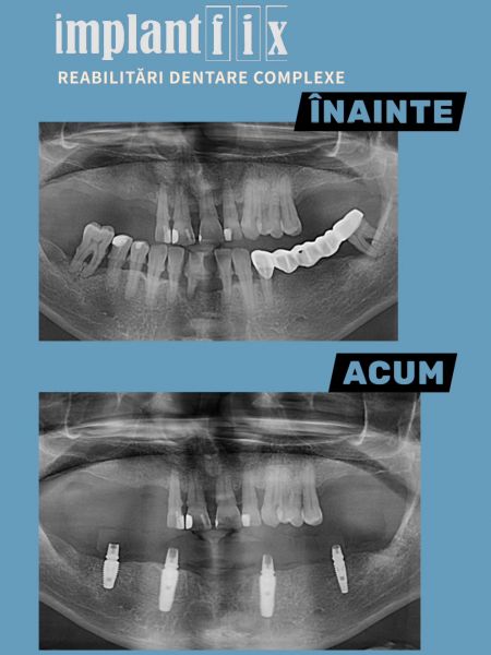 ImplantFix - Clinica de Implanturi dentare poza 15