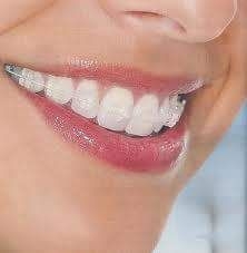 Imagine REDUCERI DE PRET LA  LA APARATELE ORTODONTICE (DENTARE) FIXE
