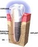 Imagine Oferta implanturi dentare