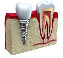 Imagine Implant dentar + coroana ceramica = 3500 lei