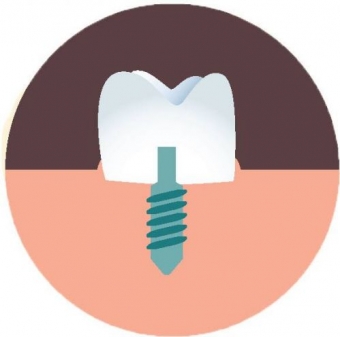 Imagine Oferta Implant dentar + coroana metalo-ceramica - 1900 lei