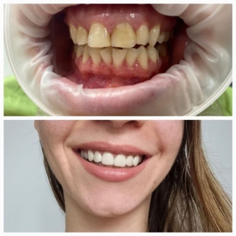 Imagine Albire dentara Sector 6 lampa Zoom Philips