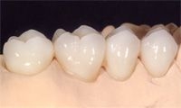 Imagine Estetica dentara- Lucrari protetice