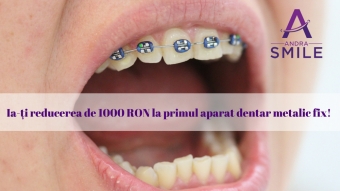 Imagine Aparat dentar metalic fix 3000 lei in loc de 4000 lei