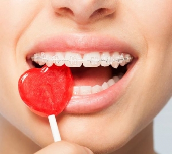 Imagine Aparate dentare Timisoara - Smileway Stoma Clinic