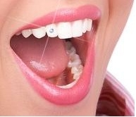 Imagine Bijuterii Dentare Galati