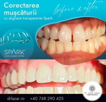 Imagine Aparate dentare invizibile Spark Oradea - Dr. Lazar Adela