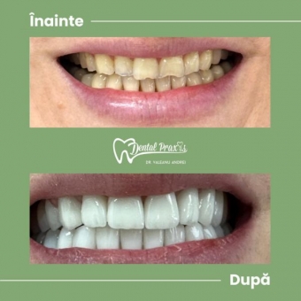 Imagine Coroane dentare Empress Timisoara Dental Praxis