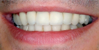 Imagine Coroane dentare metalo-ceramice sau zirconiu, Eurodent Millenium