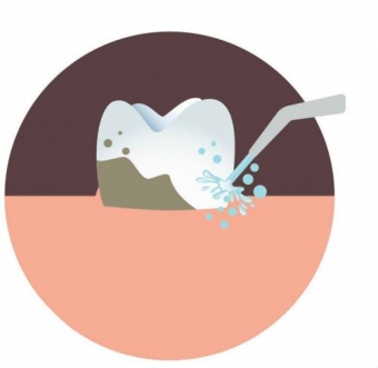 Imagine Detartraj cu ultrasunete + periaj profesional + airflow+fluorizare