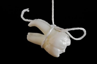 Imagine EXTRACTIE DENTARA 