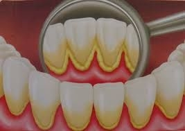 Imagine Promotie Igienizare Dentara, 40%reducere
