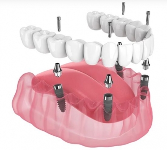 Imagine Implant dentar Buzau - DentalBlue