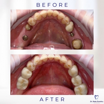 Imagine Implant dentar Pitesti - Dr. Radu Dumitru