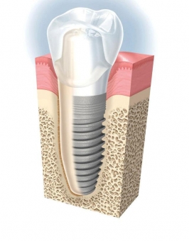 Imagine Promotia primaverii: implantul dentar