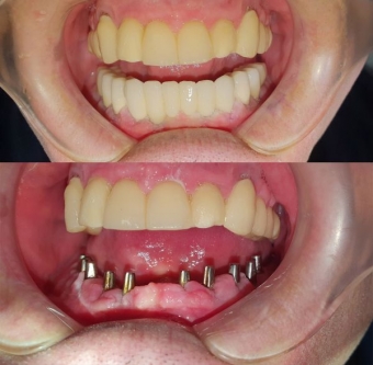 Imagine Implant dentar Tulcea – Cristian Medical Dent