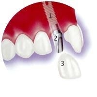 Imagine Dental Implants - 450 euro