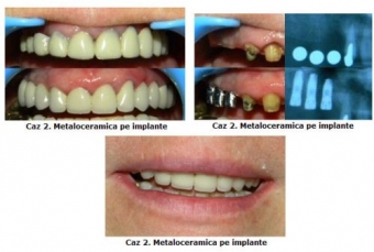 Imagine Implant dentar de la 280E