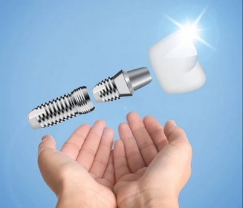 Imagine Implant dentar la pret special. Discount 100 EUR/implant!