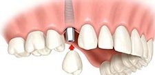Imagine OFERTA Implant dentar AlphaBio 400 euro