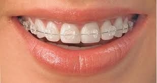 Imagine Aparate dentare fixe