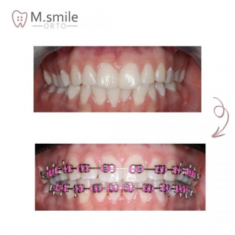 Imagine Plata in rate aparat dentar, MSmile Orto