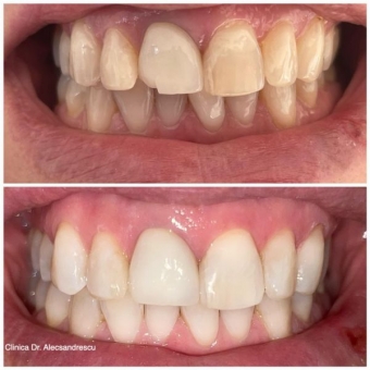 Imagine Restaurare dinte crapat - Dr. Clinica Dr. Alecsandrescu