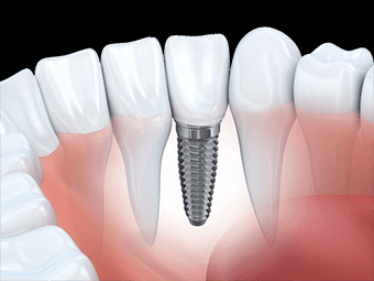 Imagine  15% reducere Implant Dentar