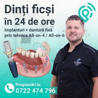 Avantajele implanturilor dentare