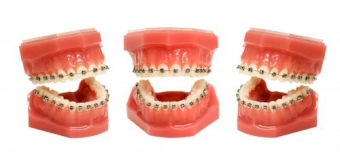 Aparat dentar fix